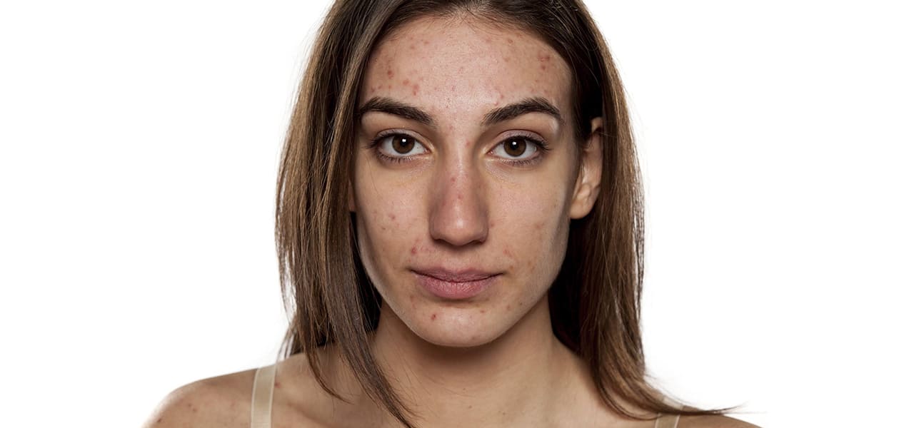 acne prone skin